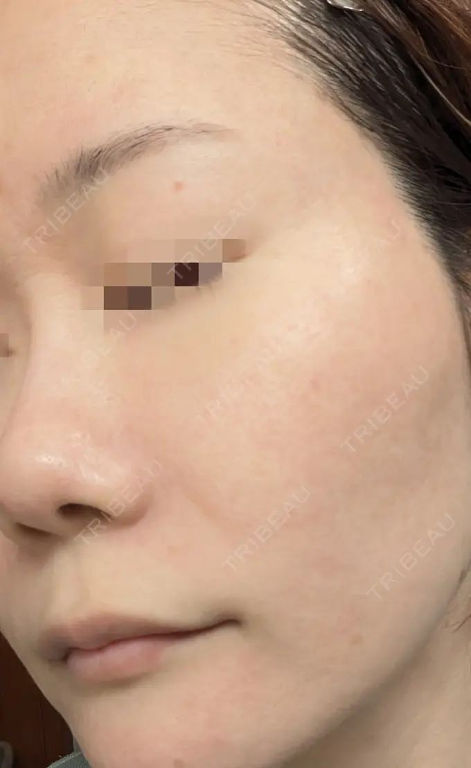 水光注射（ハリ・美肌） / ピーリング（ニキビ・毛穴） / ピーリング（ハリ・ツヤ） DAILY SKIN CLINIC 心斎橋院 DAY 8 メイン用