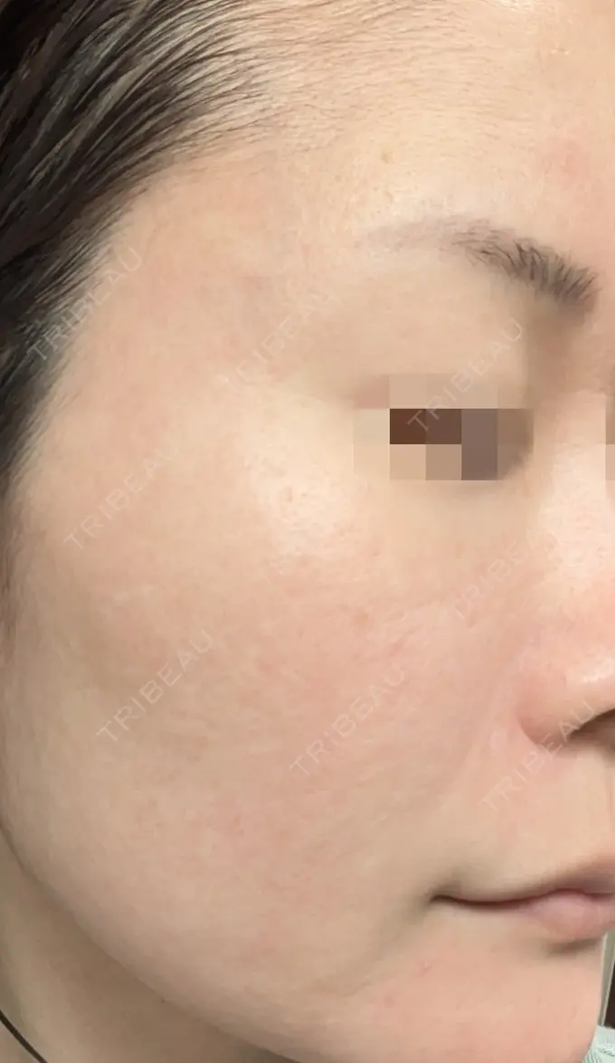 水光注射（ハリ・美肌） / ピーリング（ニキビ・毛穴） / ピーリング（ハリ・ツヤ） DAILY SKIN CLINIC 心斎橋院 DAY 8 メイン用