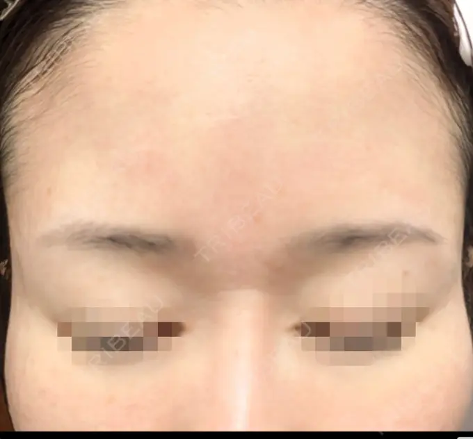 水光注射（ハリ・美肌） / ピーリング（ニキビ・毛穴） / ピーリング（ハリ・ツヤ） DAILY SKIN CLINIC 心斎橋院 DAY 8 メイン用