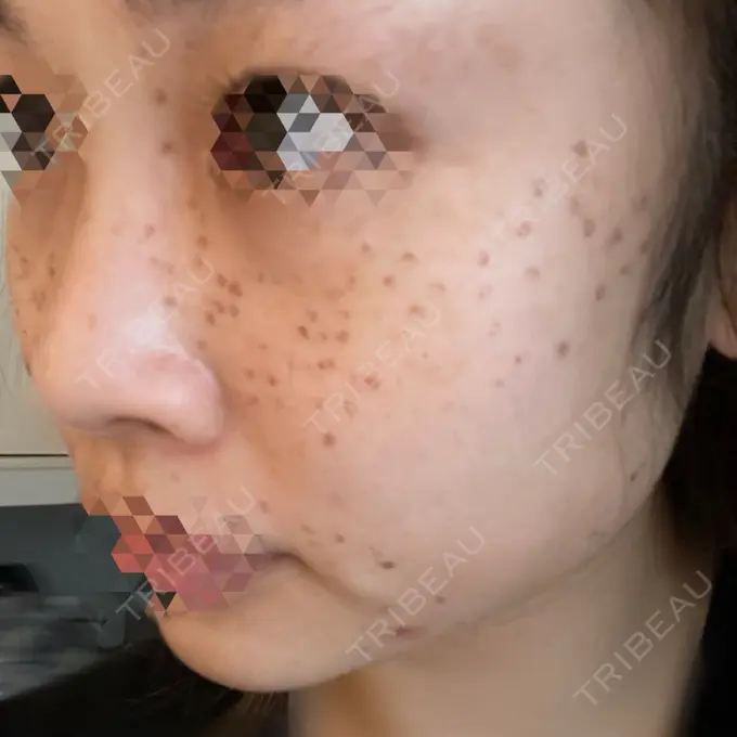 ほくろ・いぼ切除（肌） 東京シルククリニック 新宿院 DAY 2 メイン用