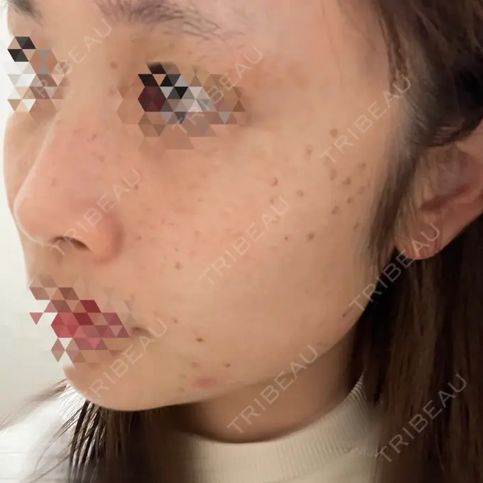 ほくろ・いぼ切除（肌） 東京シルククリニック 新宿院 DAY 7 メイン用