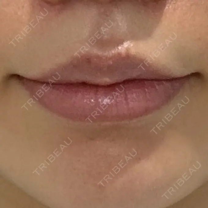 人中短縮 eクリニック 大阪梅田 西日本統括院 DAY 109 メイン用