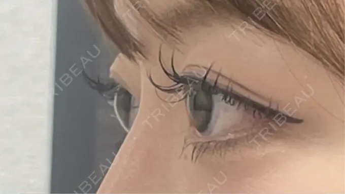 ヒアルロン酸注入（鼻） / ボトックス（エラ・小顔） 新未来クリニック AFTER メイン用