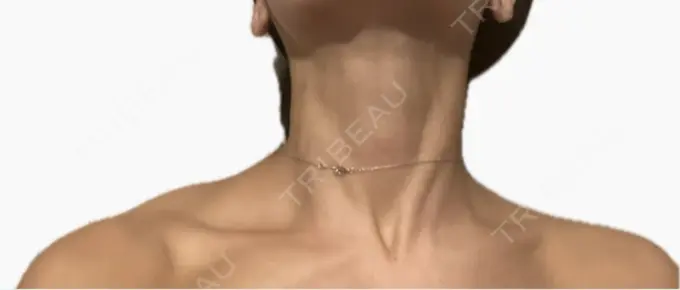 ボトックス（肩） / ボトックス（首） アールクリニック DAY 3 メイン用