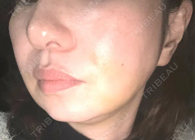 糸リフト / バッカルファット除去 / 脂肪吸引（顔） / 脂肪吸引注射（顔） 東京シンデレラ美容外科 池袋院 DAY 7 メイン用