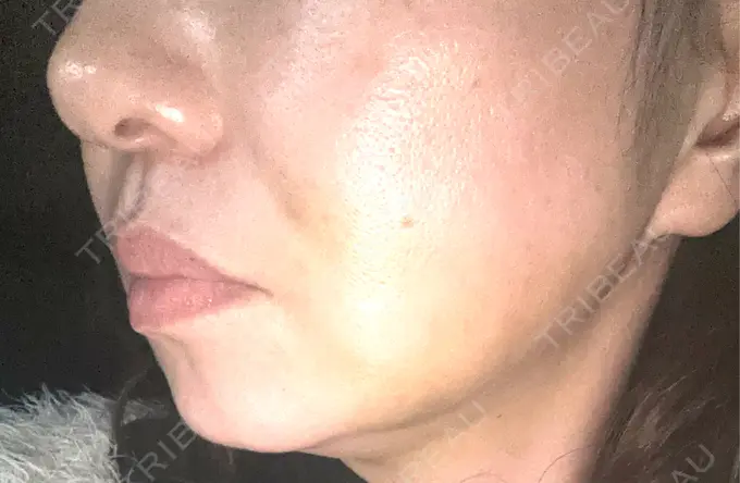 糸リフト / バッカルファット除去 / 脂肪吸引（顔） / 脂肪吸引注射（顔） 東京シンデレラ美容外科 池袋院 DAY 7 メイン用