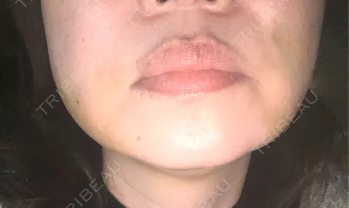 糸リフト / バッカルファット除去 / 脂肪吸引（顔） / 脂肪吸引注射（顔） 東京シンデレラ美容外科 池袋院 DAY 7 メイン用