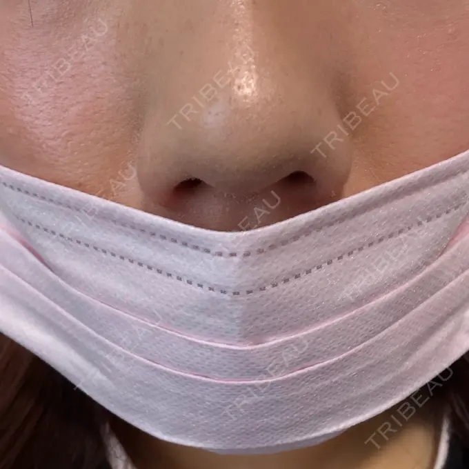 小鼻縮小（非切開） しのぶ皮膚科 AFTER メイン用