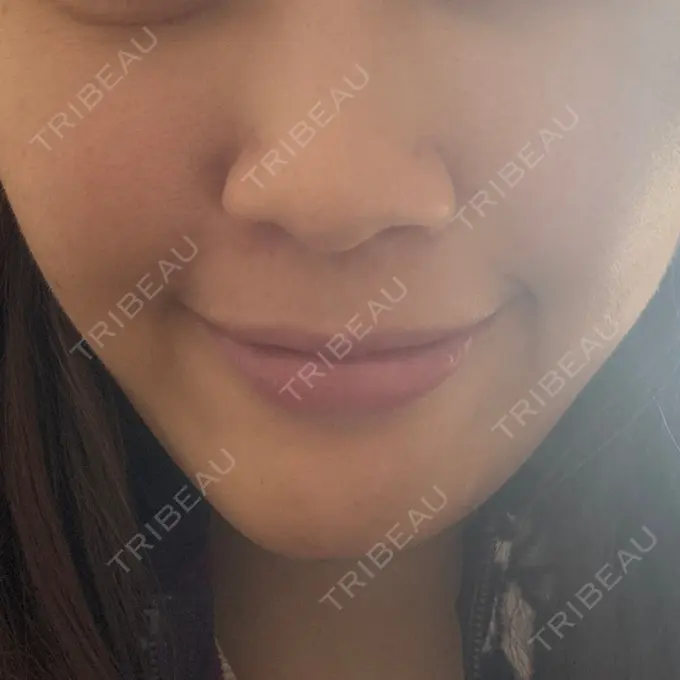 脂肪溶解注射（顔） 日比谷セントラルクリニック DAY 1 メイン用