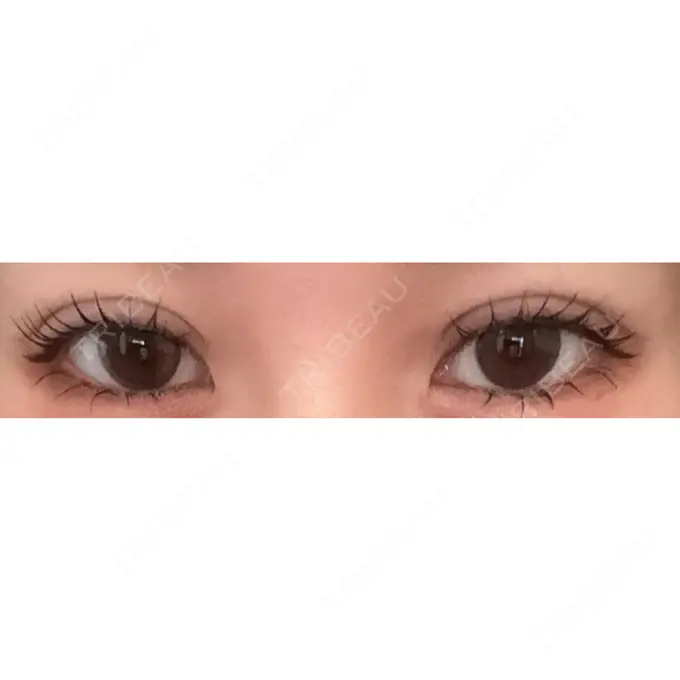 二重埋没 アリエル美容クリニック 水戸院 DAY 6 メイン用