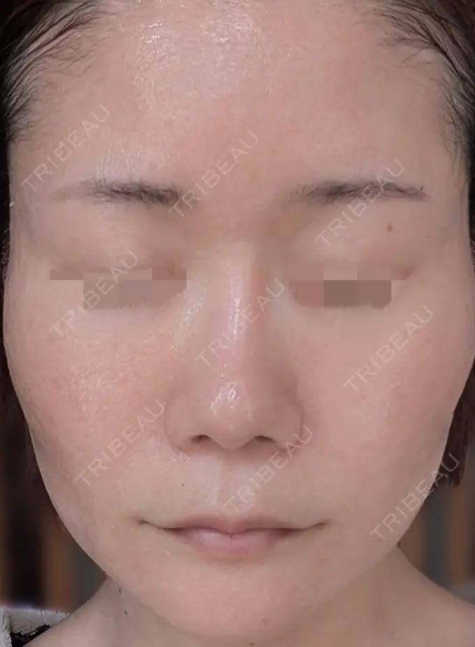 水光注射（ハリ・美肌） / ピーリング（ニキビ・毛穴） / ピーリング（ハリ・ツヤ） DAILY SKIN CLINIC 心斎橋院 DAY 9 メイン用