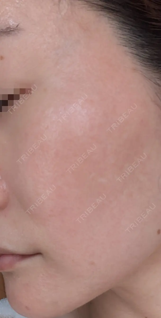 水光注射（ハリ・美肌） / ピーリング（ニキビ・毛穴） / ピーリング（ハリ・ツヤ） DAILY SKIN CLINIC 心斎橋院 DAY 9 メイン用