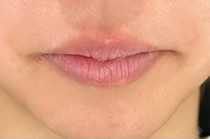 ヒアルロン酸注入（唇） HAAB×DREAM BEAUTY CLINIC 大阪梅田院 DAY 0 メイン用