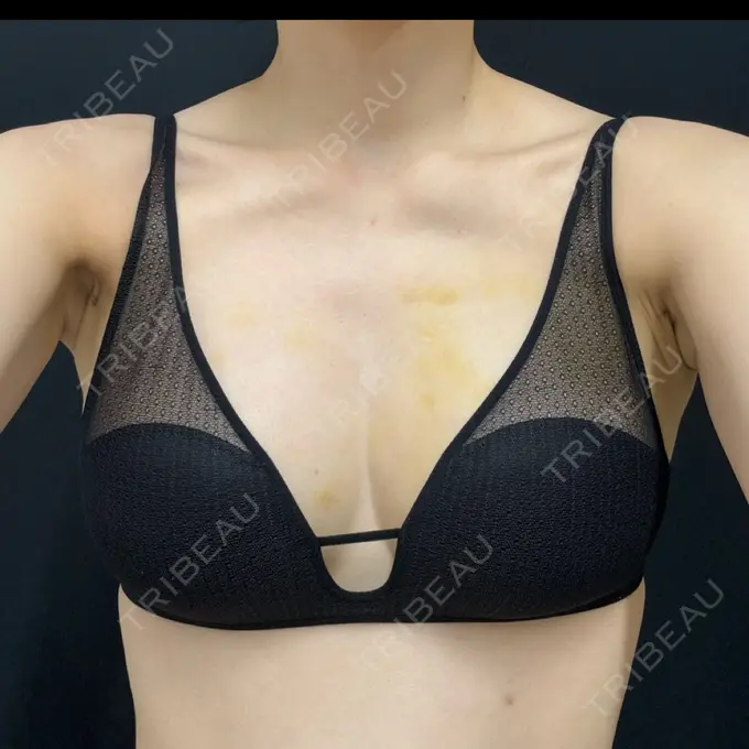 脂肪吸引（脚） / 豊胸（脂肪注入） 湘南美容クリニック Regno 銀座院 DAY 7 メイン用