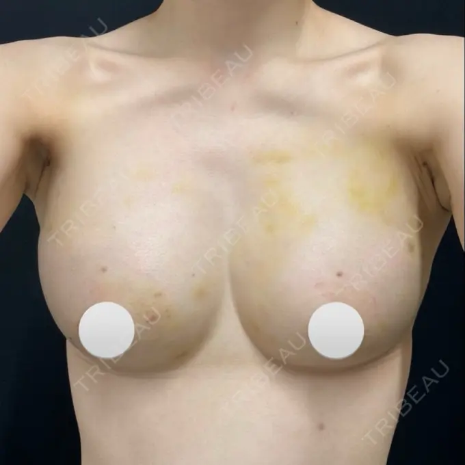 脂肪吸引（脚） / 豊胸（脂肪注入） 湘南美容クリニック Regno 銀座院 DAY 7 メイン用