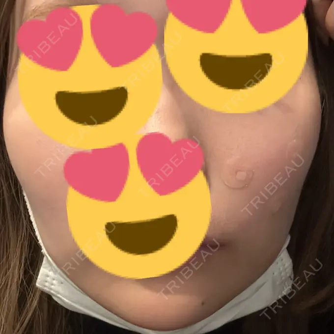 ほくろ・いぼ除去レーザー（肌） 共立美容外科 名古屋院 DAY 4 メイン用