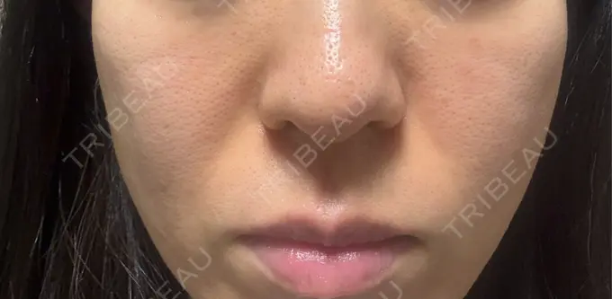 ジャルプロ 城本クリニック 静岡院 DAY 5 メイン用