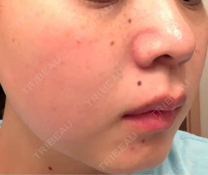 イオン導入 / ピーリング（ハリ・ツヤ） / ルメッカ ルラ美容クリニック 仙台院 / ルラスキンクリニック 仙台院 DAY 13 メイン用