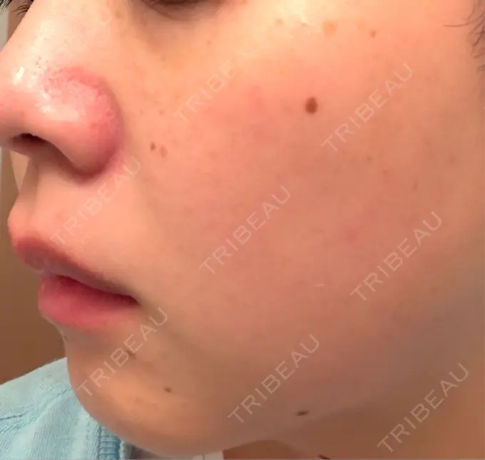 イオン導入 / ピーリング（ハリ・ツヤ） / ルメッカ ルラ美容クリニック 仙台院 / ルラスキンクリニック 仙台院 DAY 13 メイン用