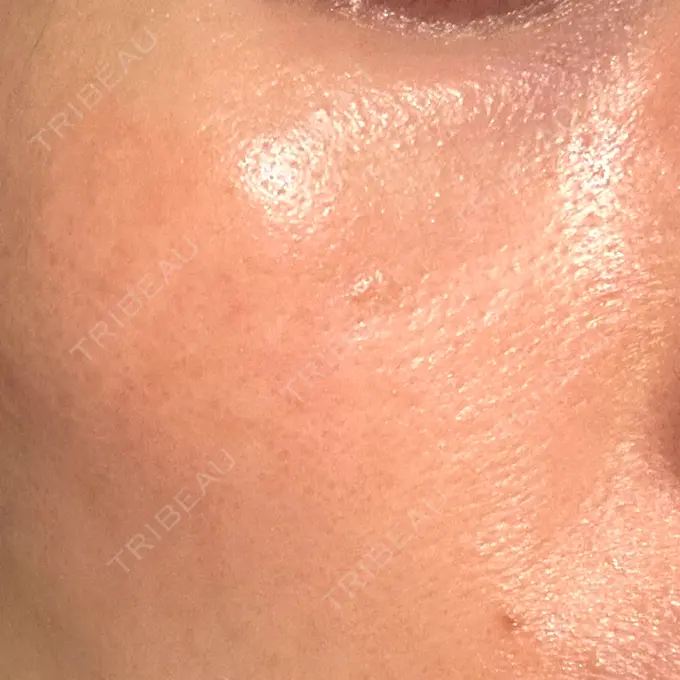 LDM・インテンスウルトラ 品川スキンクリニック広島院 DAY 9 メイン用