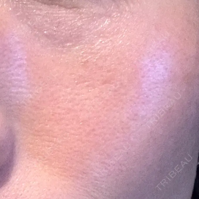 RF（高周波）たるみ治療 湘南美容クリニック 広島院 DAY 4 メイン用