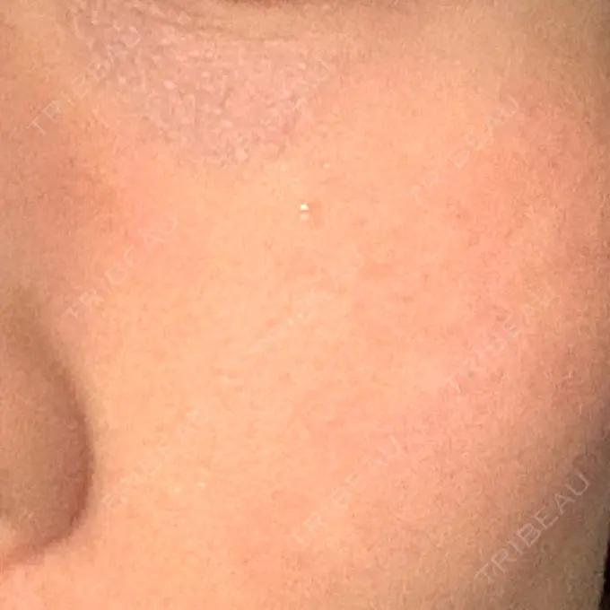 RF（高周波）たるみ治療 湘南美容クリニック 広島院 DAY 5 メイン用