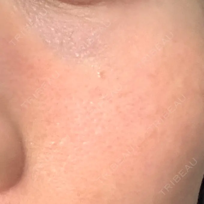 RF（高周波）たるみ治療 湘南美容クリニック 広島院 DAY 6 メイン用