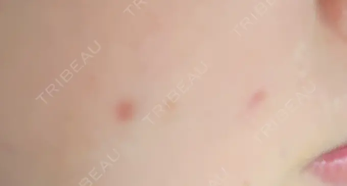 ほくろ・いぼ切除（肌） 札幌中央クリニック DAY 18 メイン用