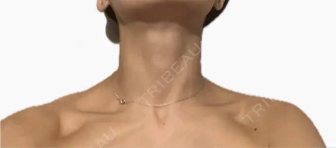 ボトックス（肩） / ボトックス（首） アールクリニック DAY 4 メイン用