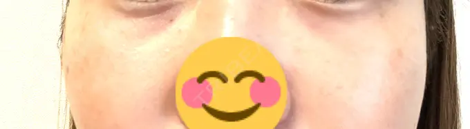 下まぶたたるみ取り / 脂肪注入（目の下） プラストクリニック AFTER メイン用