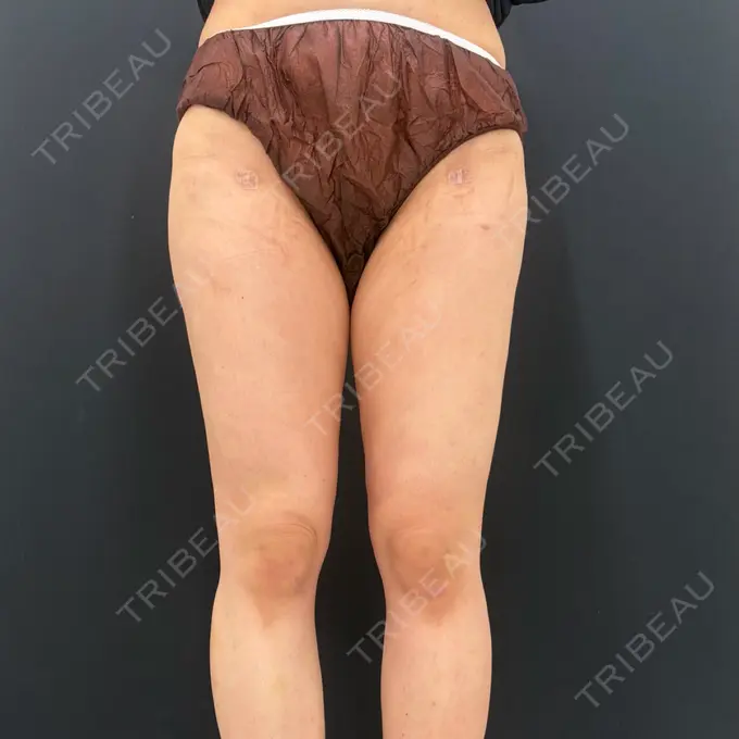 脂肪吸引（脚） / 脂肪吸引（お尻） 湘南美容クリニック 名古屋駅本院 AFTER メイン用