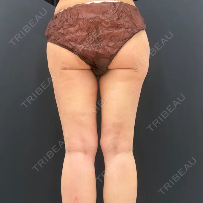 脂肪吸引（脚） / 脂肪吸引（お尻） 湘南美容クリニック 名古屋駅本院 DAY 35 メイン用