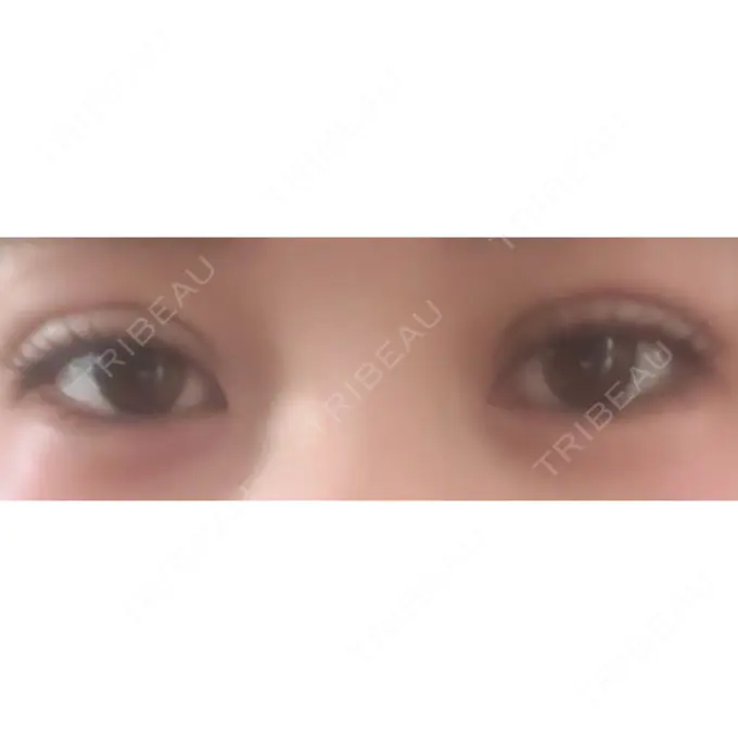 二重埋没 アリエル美容クリニック 水戸院 DAY 8 メイン用