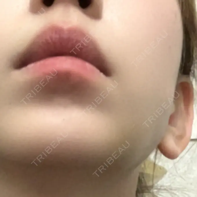 糸リフト / 脂肪吸引（顔） / ジョールファット除去 / ヒアルロン酸注入（あご） 新宿美容外科ネビュラクリニック AFTER メイン用