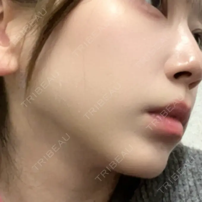 糸リフト / 脂肪吸引（顔） / ジョールファット除去 / ヒアルロン酸注入（あご） 新宿美容外科ネビュラクリニック DAY 7 メイン用