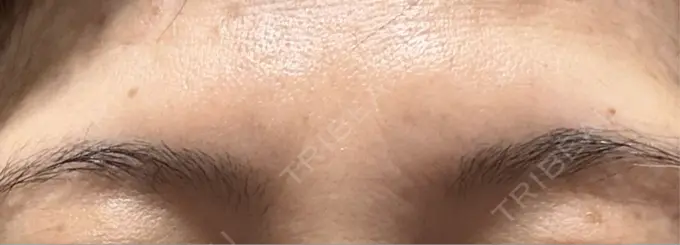 ボトックス（あご） / ボトックス（眉間） / ボトックス（目尻） / ボトックス（額） 湘南美容クリニック 金山院 AFTER メイン用