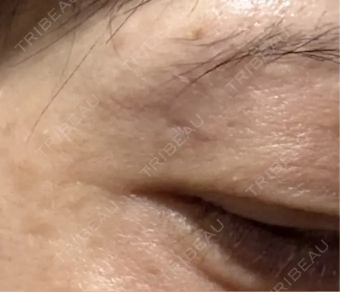 ボトックス（あご） / ボトックス（眉間） / ボトックス（目尻） / ボトックス（額） 湘南美容クリニック 金山院 DAY 3 メイン用