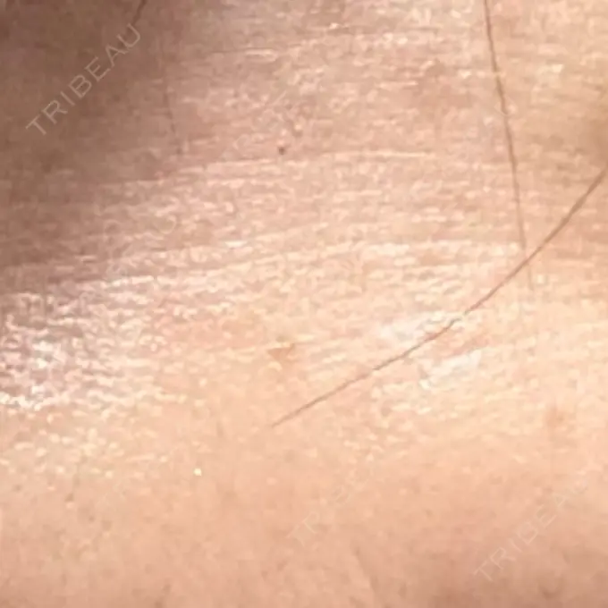 ボトックス（あご） / ボトックス（眉間） / ボトックス（目尻） / ボトックス（額） 湘南美容クリニック 金山院 DAY 3 メイン用