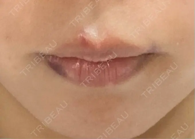 ヒアルロン酸注入（唇） HAAB×DREAM BEAUTY CLINIC 大阪梅田院 DAY 1 メイン用