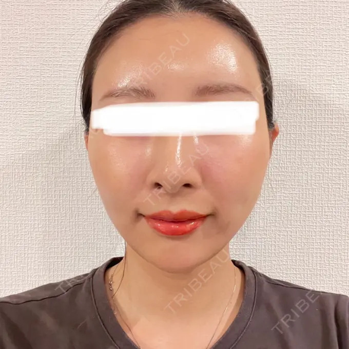 糸リフト / 脂肪吸引（顔） / 額を丸く / 脂肪注入（額） / ジョールファット除去 / 脂肪吸引注射（顔） / 脂肪注入（輪郭） / 美容点滴・美容注射（疲労回復） / その他 SEA CLINIC（シークリニック） DAY 16 メイン用