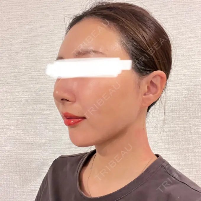 糸リフト / 脂肪吸引（顔） / 額を丸く / 脂肪注入（額） / ジョールファット除去 / 脂肪吸引注射（顔） / 脂肪注入（輪郭） / 美容点滴・美容注射（疲労回復） / その他 SEA CLINIC（シークリニック） DAY 16 メイン用