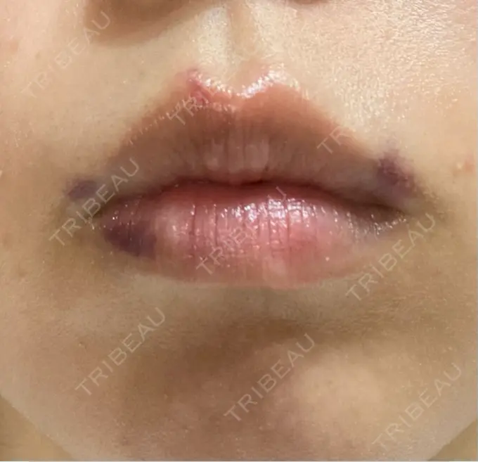 ヒアルロン酸注入（唇） HAAB×DREAM BEAUTY CLINIC 大阪梅田院 DAY 1 メイン用