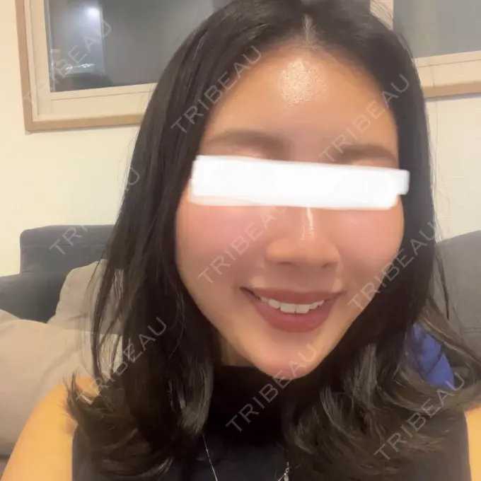 糸リフト / 脂肪吸引（顔） / 額を丸く / 脂肪注入（額） / ジョールファット除去 / 脂肪吸引注射（顔） / 脂肪注入（輪郭） / 美容点滴・美容注射（疲労回復） / その他 SEA CLINIC（シークリニック） AFTER メイン用