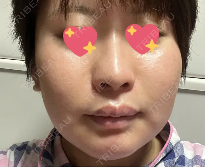 ハイフ（顔） しんゆり美容健康クリニック AFTER メイン用