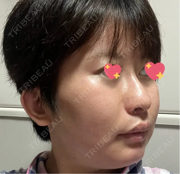 ハイフ（顔） しんゆり美容健康クリニック DAY 7 メイン用