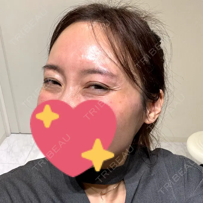 ボトックス（あご） / ヒアルロン酸注入（あご） / ヒアルロン酸注入（頬） DMTC CLINIC 渋谷院 DAY 0 メイン用