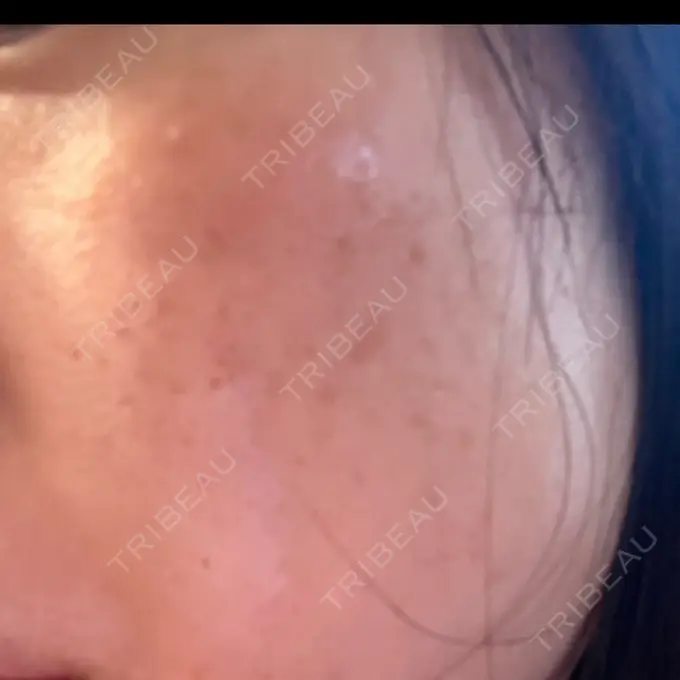 フラクショナルレーザー（毛穴・ニキビ跡） Designo Clinic （デジーノクリニック） DAY 4 メイン用