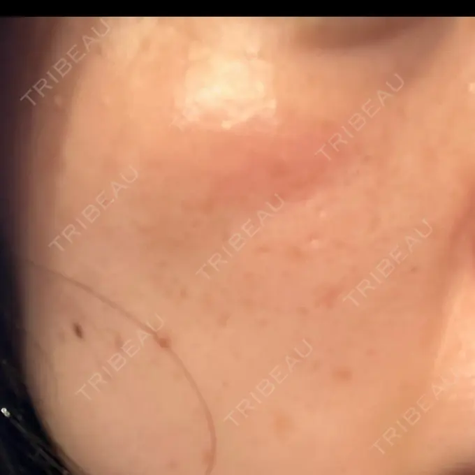 フラクショナルレーザー（毛穴・ニキビ跡） Designo Clinic （デジーノクリニック） DAY 4 メイン用