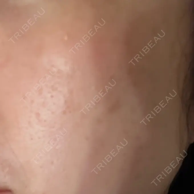 フラクショナルレーザー（毛穴・ニキビ跡） Designo Clinic （デジーノクリニック） DAY 5 メイン用