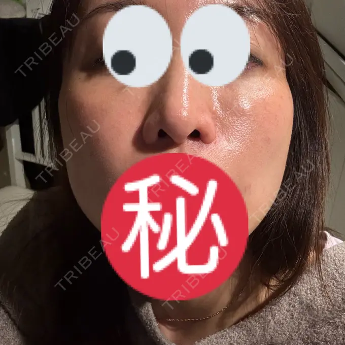 ボトックス（あご） / ヒアルロン酸注入（あご） / ヒアルロン酸注入（頬） DMTC CLINIC 渋谷院 DAY 1 メイン用